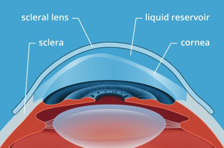 Scleral lens